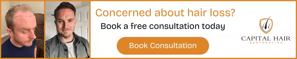 Before and after hair transplant photos with text "Concerned about hair loss? Book a free consultation today" and Capital Hair Restoration logo.