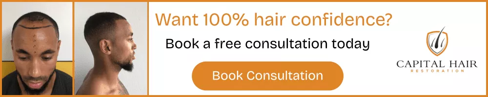 Before and after photos showing hair transplant results for a male patient with hairline restoration and side profile, promoting free consultation at Capital Hair Restoration.