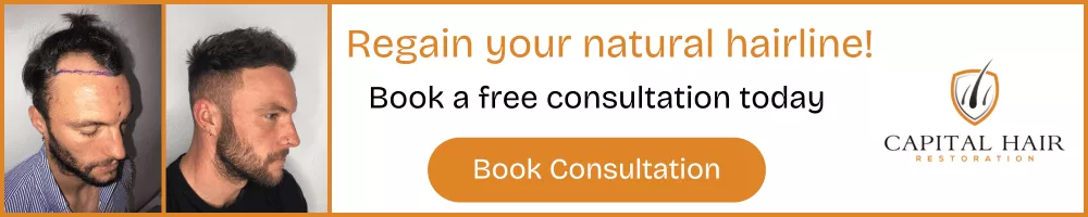 Before and after photos of a man’s hair transplant showing hairline markings and fuller hair, with text encouraging booking a free consultation