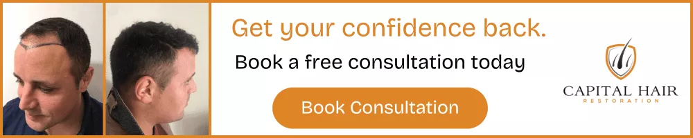 Before hair transplant photos showing hairline markings and side profile, with text encouraging booking a free consultation