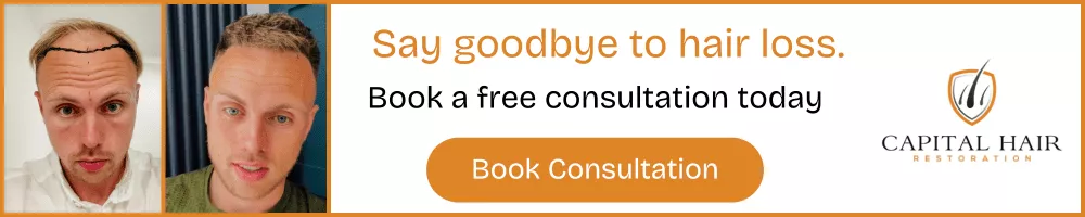 Before and after photos of a man’s hair transplant results with text encouraging booking a free consultation