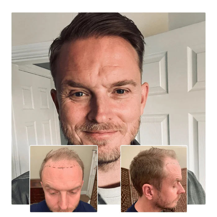 before after hair transplant portsmouth 07