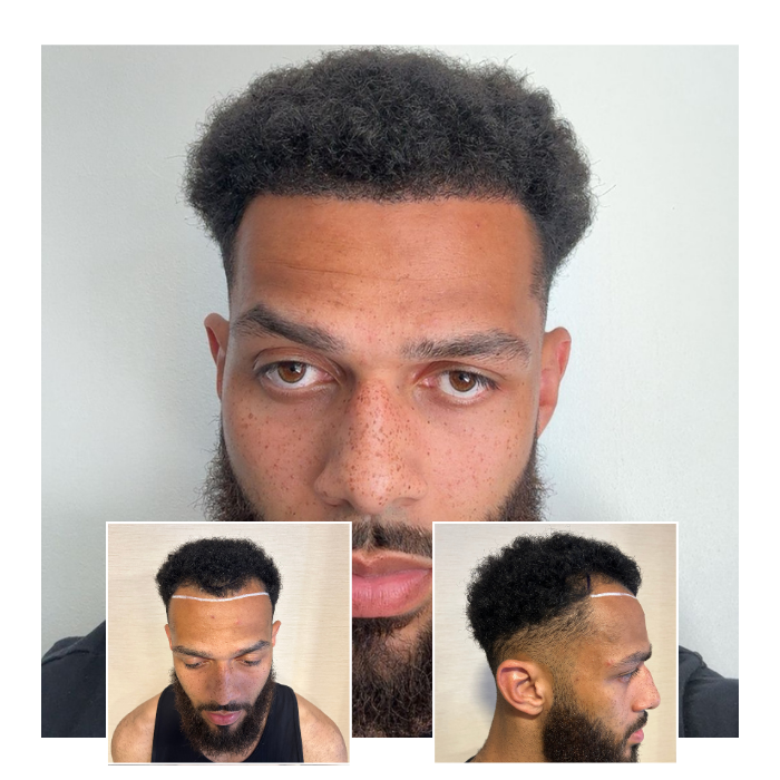 before after hair transplant southampton 06