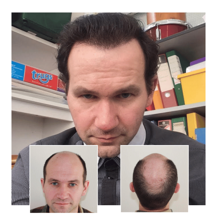 before after hair transplant southampton 07