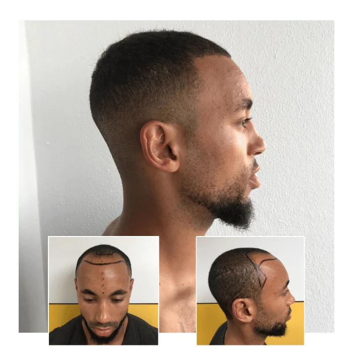 fue hair transplant before and after 07