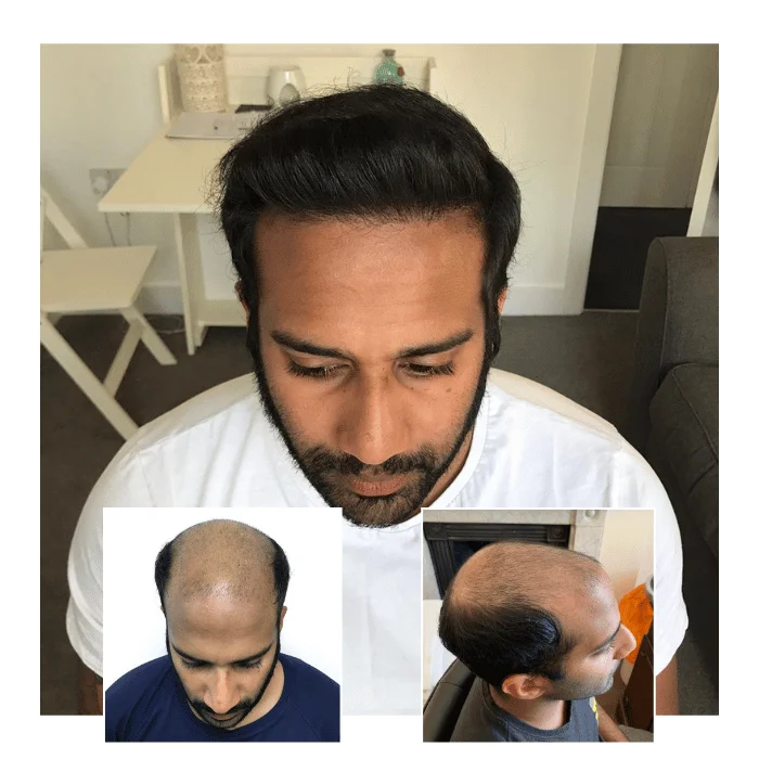 fut hair transplant before and after 3