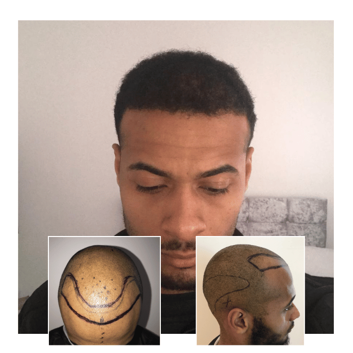 afro hair transplant brighton hove 02
