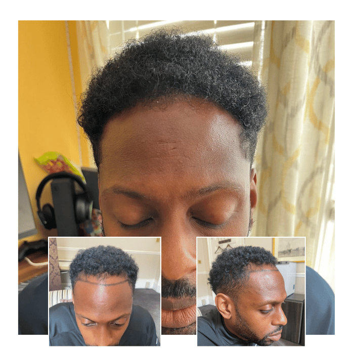 afro hair transplant brighton hove 03