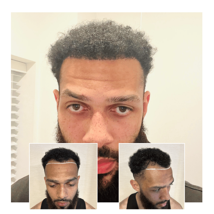 afro hair transplant brighton hove 04