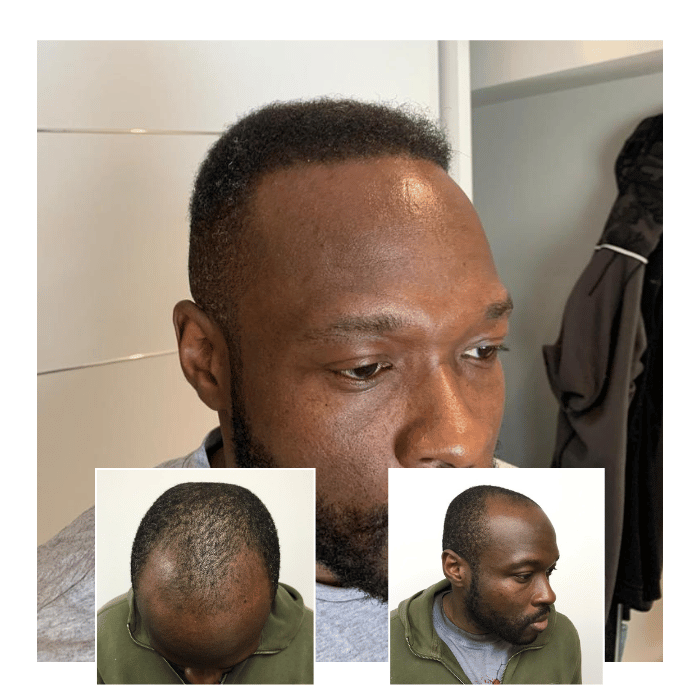 afro hair transplant brighton hove 05