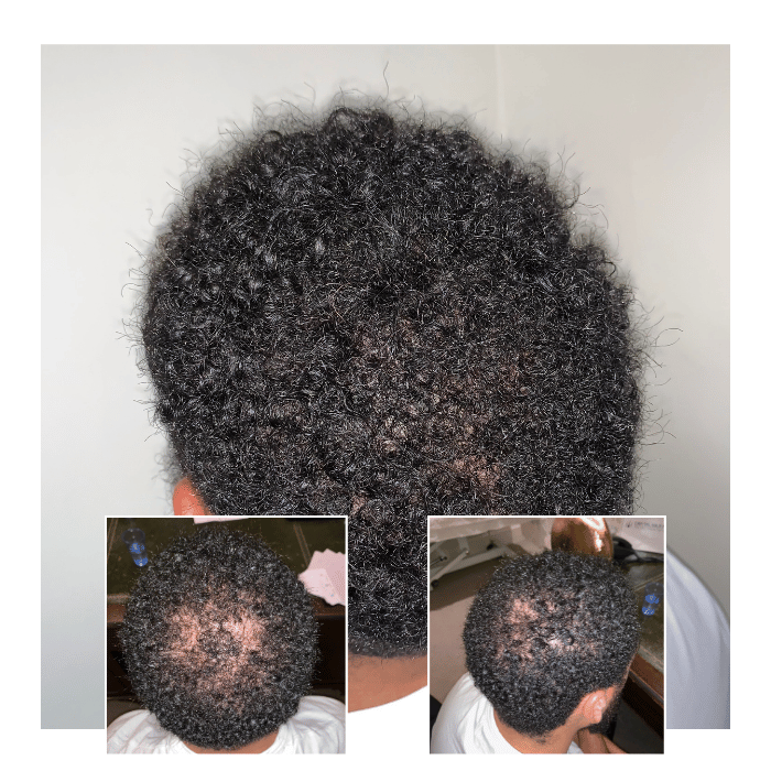 afro hair transplant clinic chelmsford essex 02