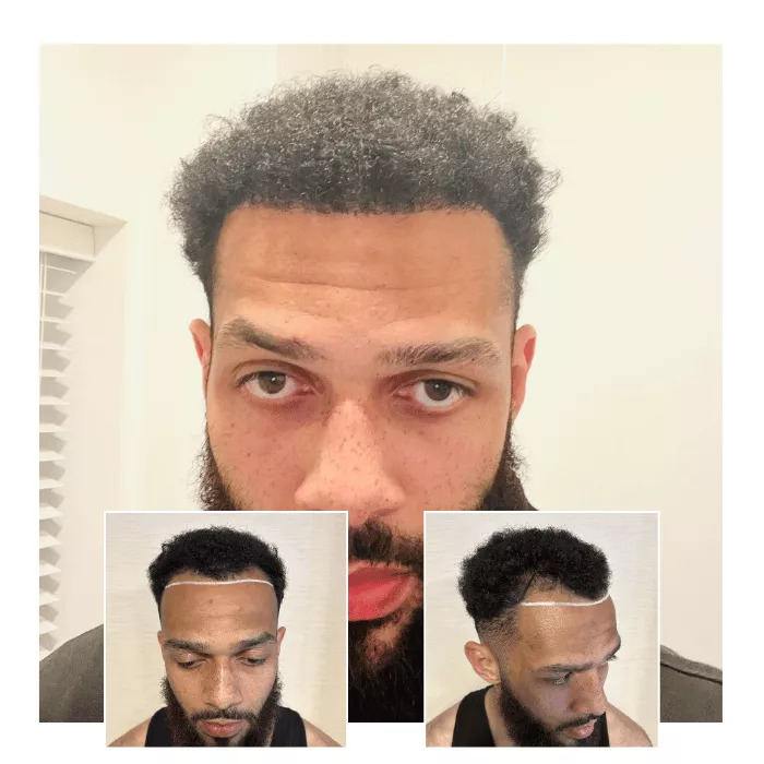 afro hair transplant clinic in cambridge 03