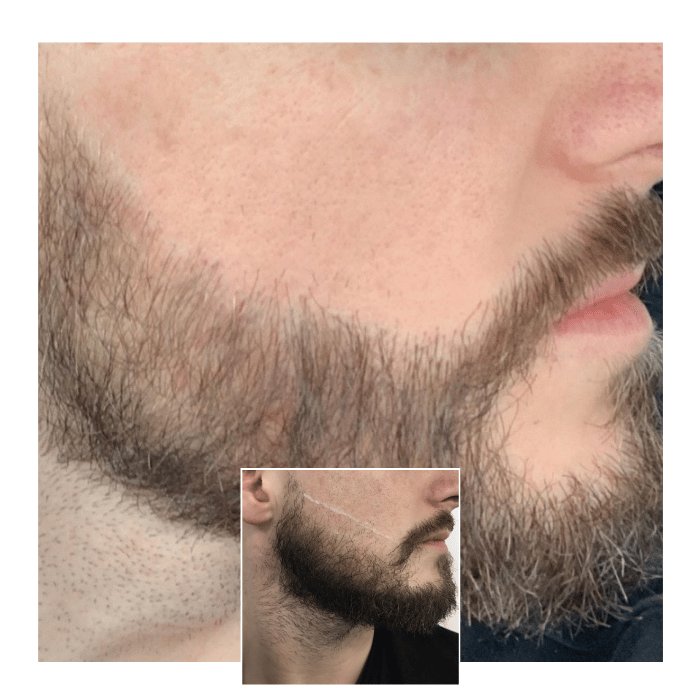 beard hair transplant brighton 02