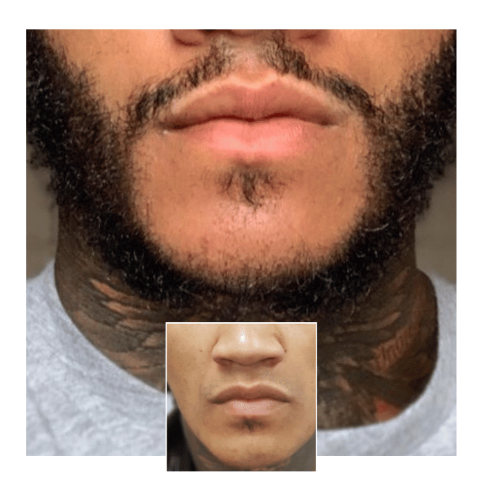 beard hair transplant brighton 03