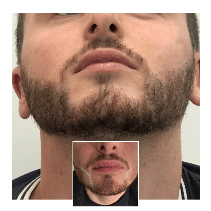 beard hair transplant brighton 05