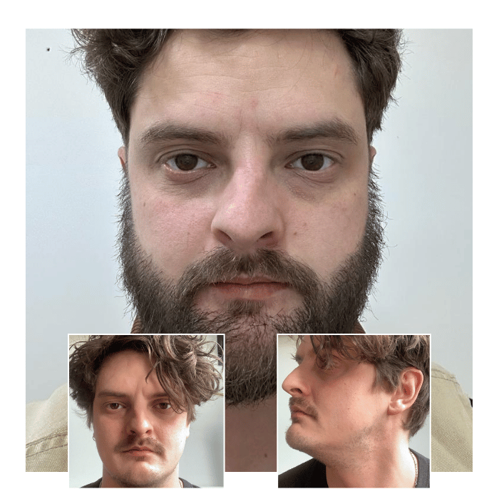 beard hair transplant chelmsford 04