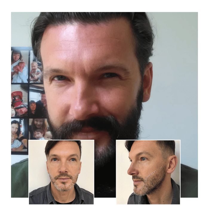 beard hair transplant ipswich 01