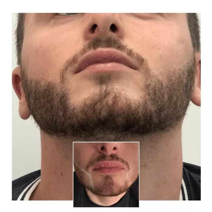 beard hair transplant oxford 05