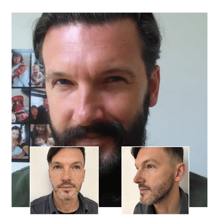 beard hair transplant canary wharf 01