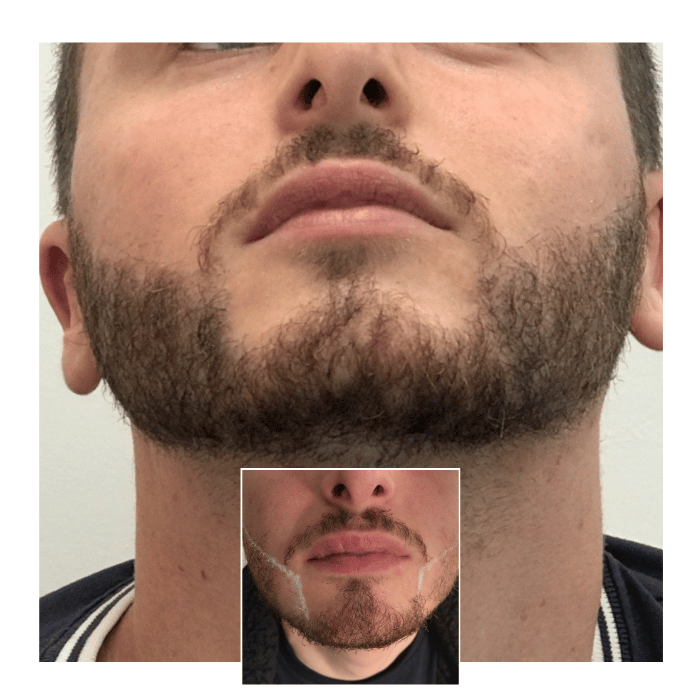 beard hair transplant canary wharf 05