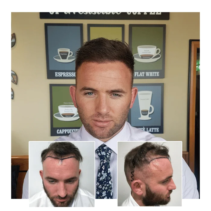 before after hair transplant canary wharf london 05
