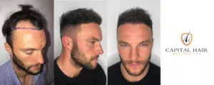 reduce pain after hair transplant,pain after hair transplant