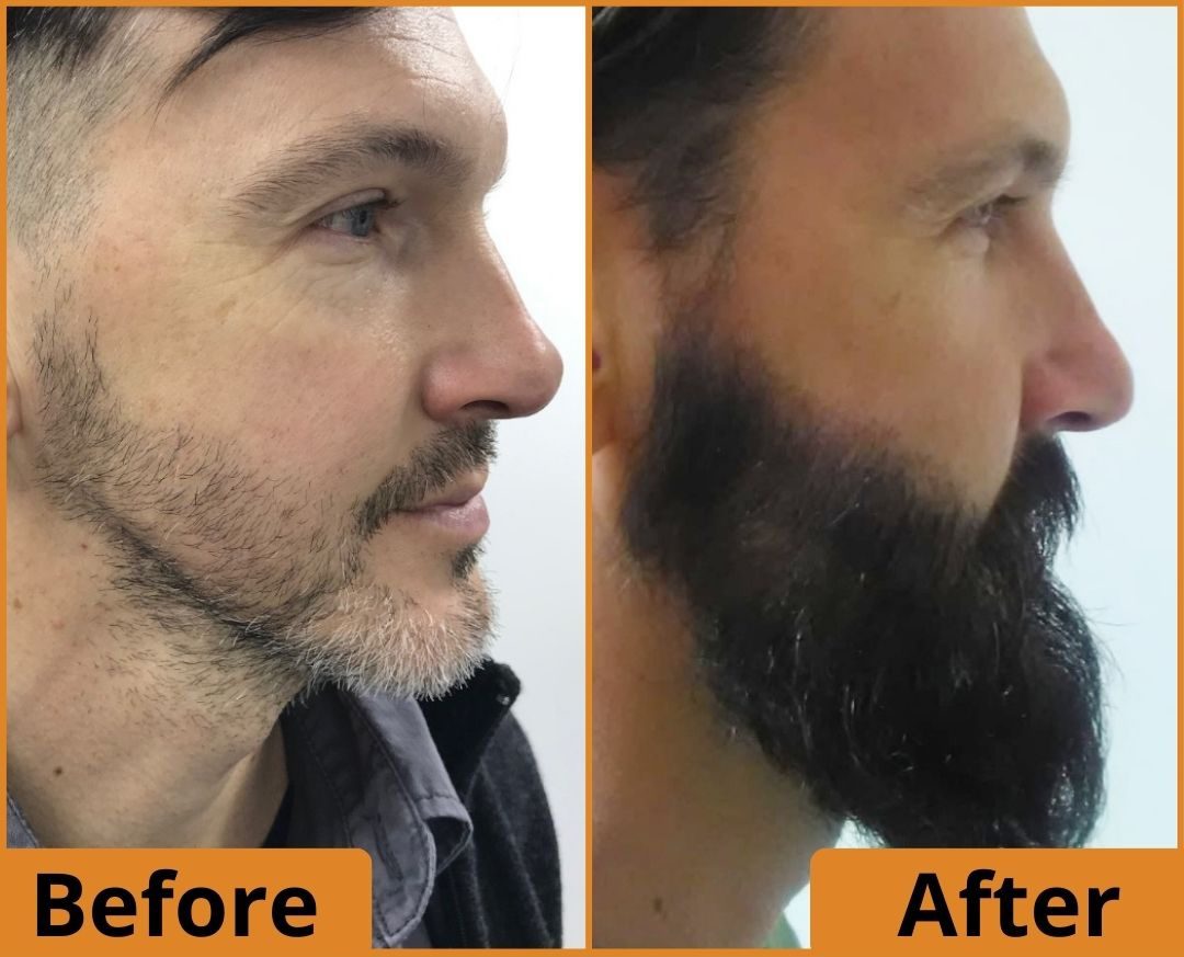 Before-After Beard Transplant