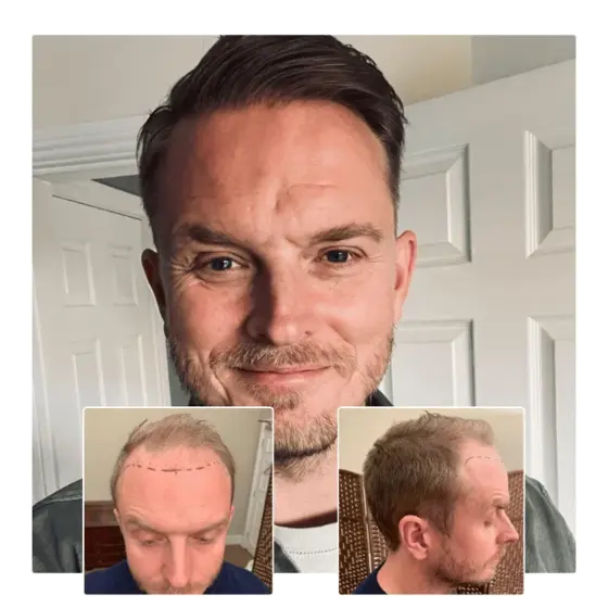 before after hair transplant bristol 03
