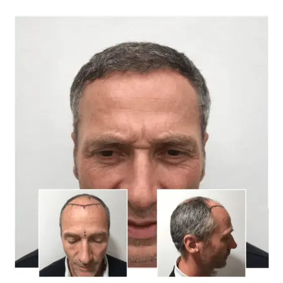 before after hair transplant bromley 04