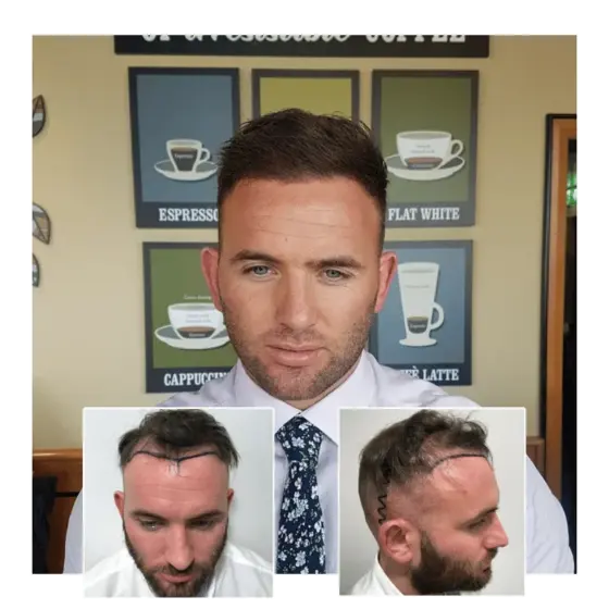 before after hair transplant bromley 05