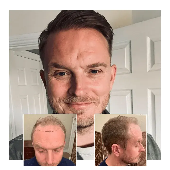 before after hair transplant milton keynes 03