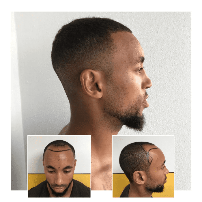 before after hair transplant portsmouth 01