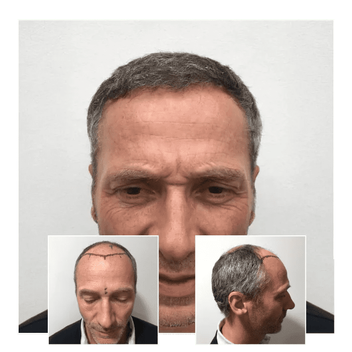 before after hair transplant portsmouth 08