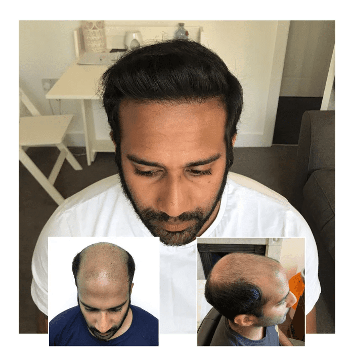 before after hair transplant reading 02