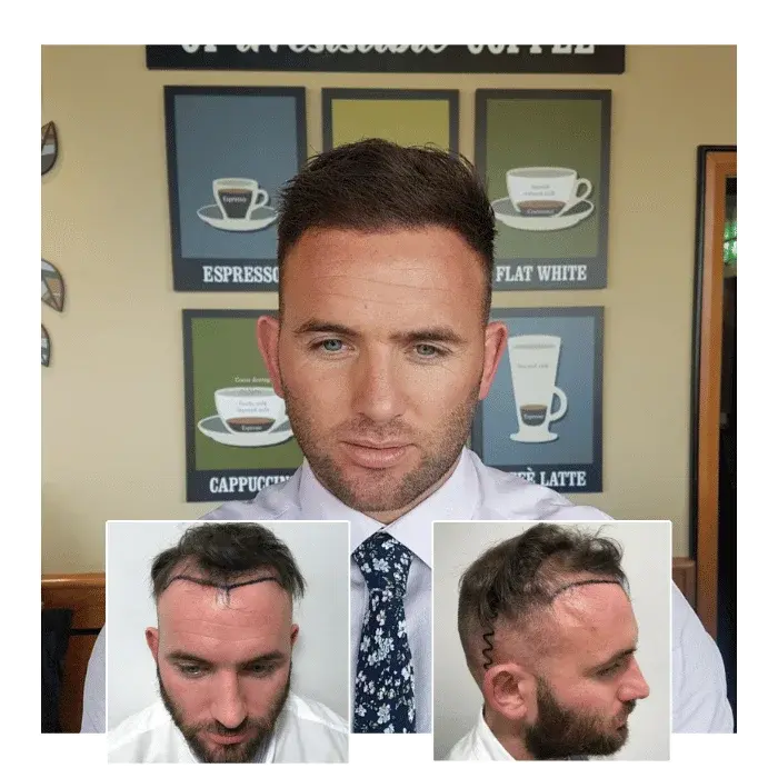 before after hair transplant reading 05
