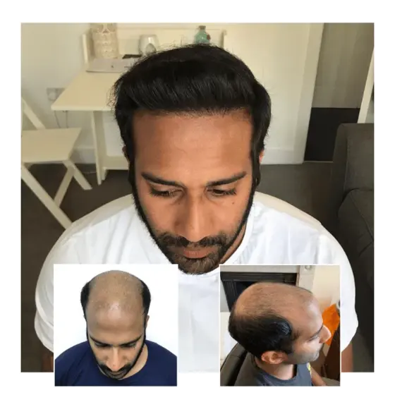 before after hair transplant southampton 02