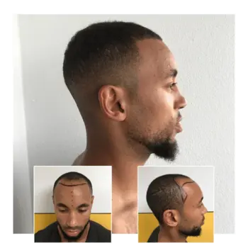 before after hair transplant watford 08