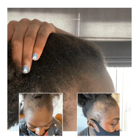 laser therapy for hair loss - woman afro