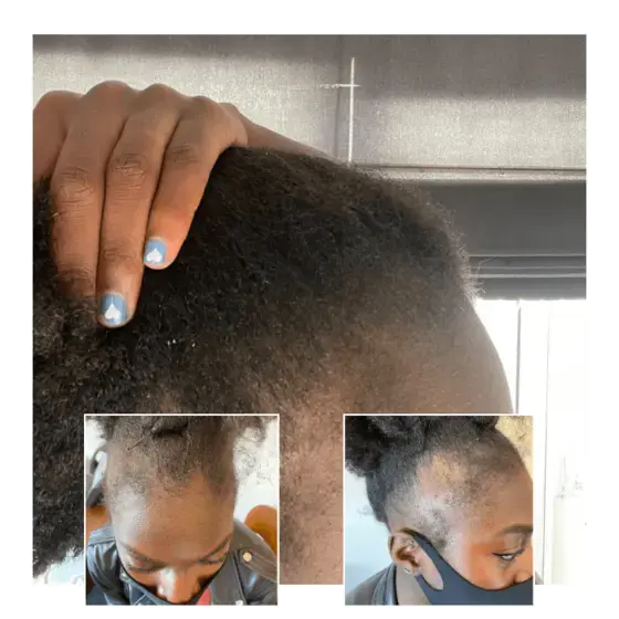 female before after hair transplant
