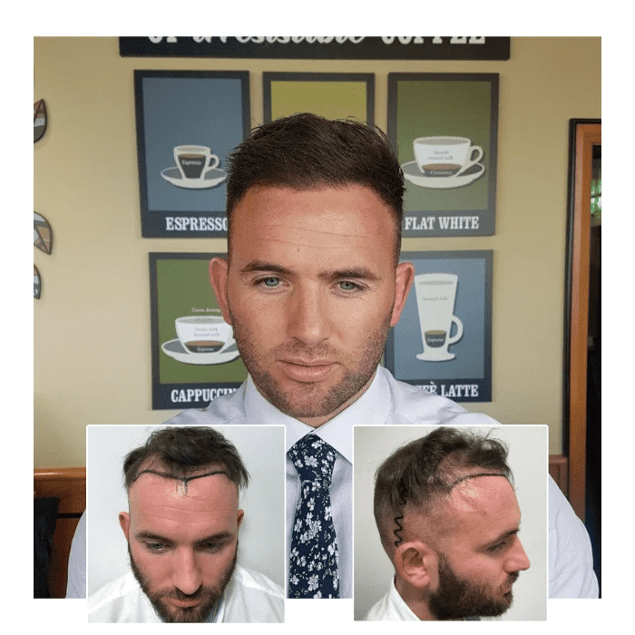 fue hair transplant before and after 04