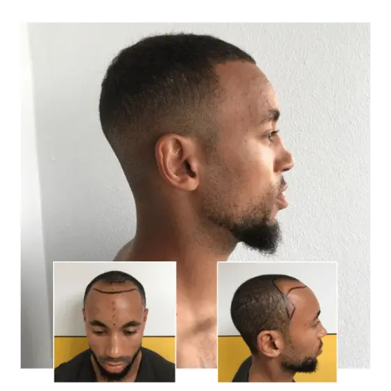 before after hair transplant bromley 08