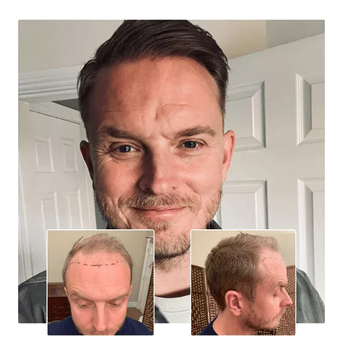 Before and after FUE hair transplant showing restored frontal hairline in male patient with early-stage recession