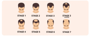 Male Pattern Baldness