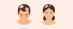 alopecia areata