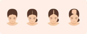 female pattern hair loss