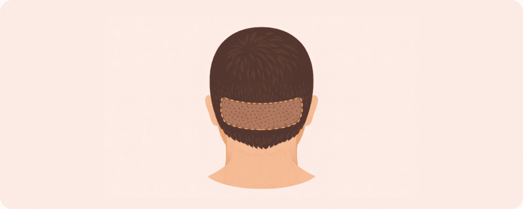 what is the doner area hair transplant