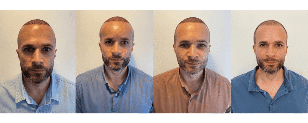why does transplanted hair shed?