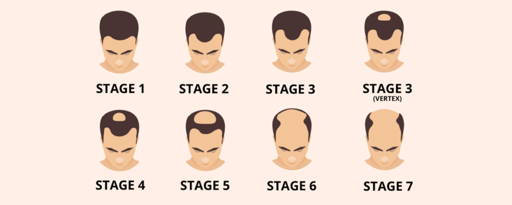 explaining the norwood scale