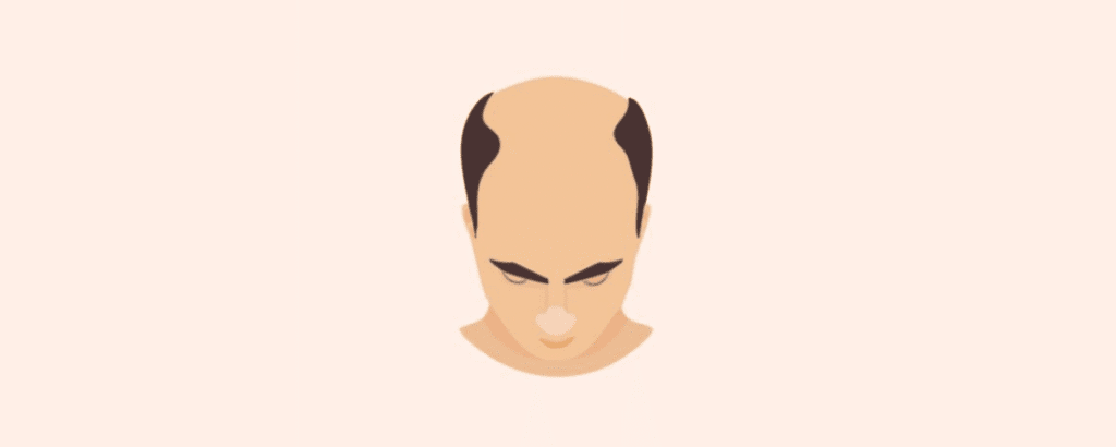 how much hair loss is too much for a hair transplant